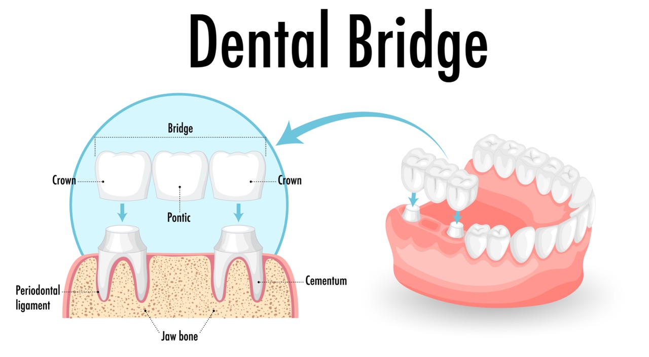 Dental Bridges in Bedford